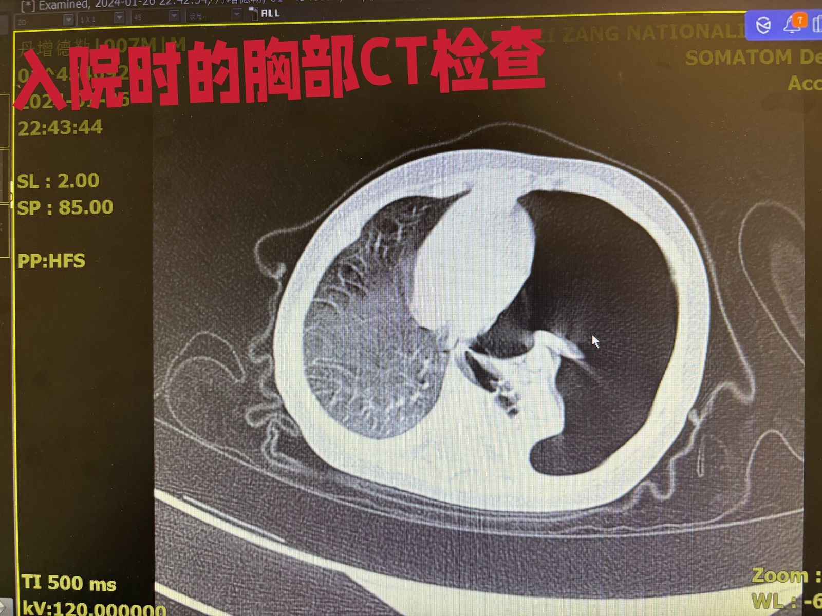 7月嬰兒重症氣胸險喪命甘醫人用心用情成功救治